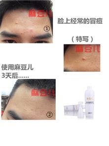 麻豆儿去黑头,告别毛孔粗大困扰